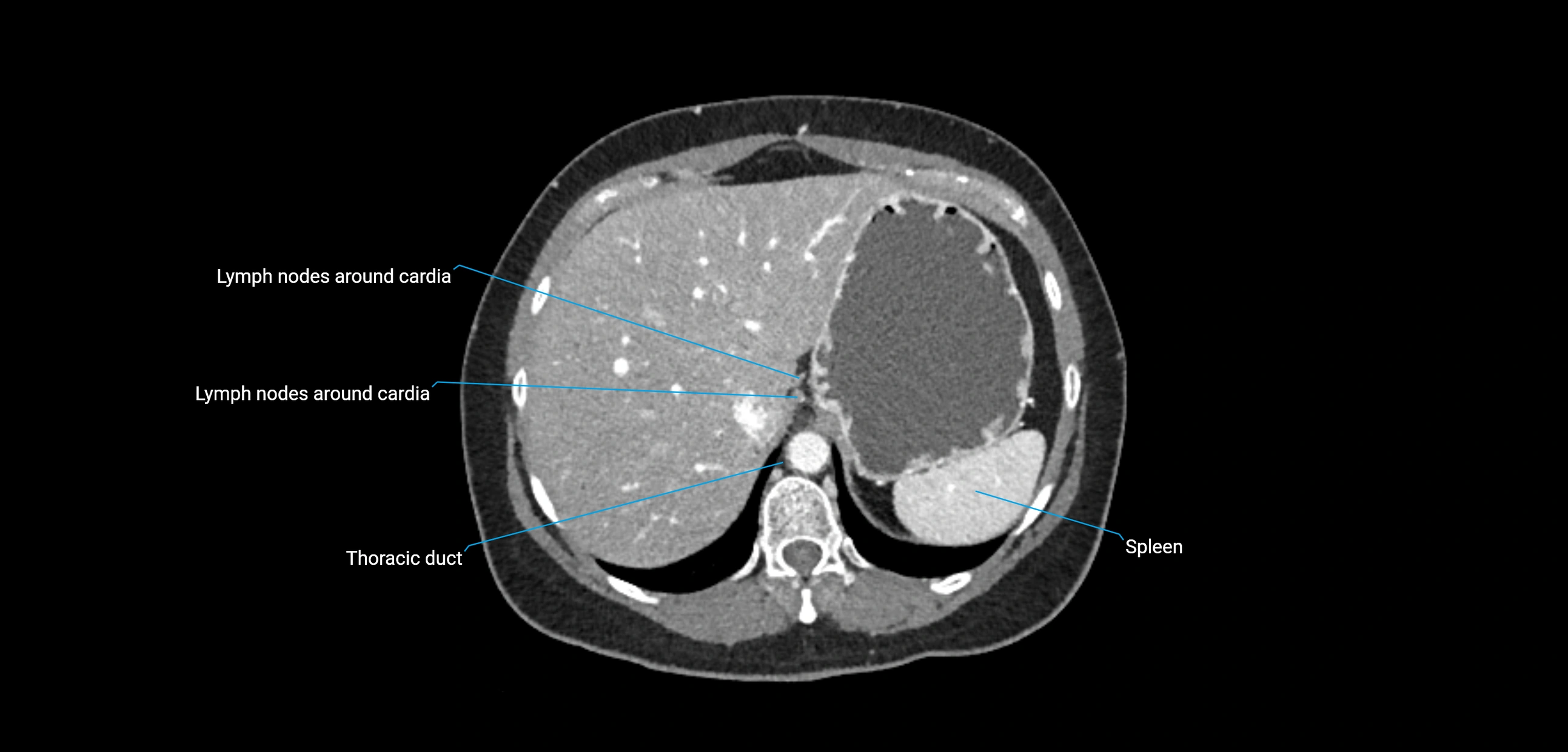 CT ct abdominal lymph nodes  axial cross sectional anatomy  enchanced radiology image -img-00002-00105.webp